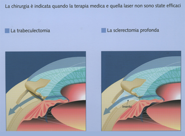 Sala operatoria per intervento chirurgico al glaucoma