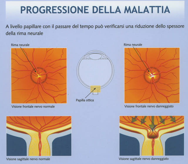 Progressione del glaucoma sul campo visivo