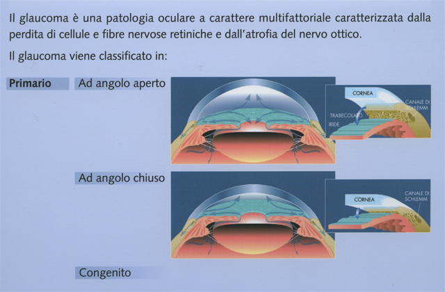 Tipologie di glaucoma — angolo aperto, chiuso, congenito, secondario