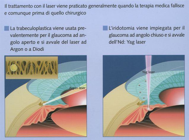 Trattamenti laser per il glaucoma: trabeculoplastica e iridotomia